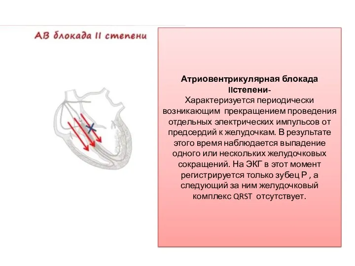 Атриовентрикулярная блокада IIстепени- Характеризуется периодически возникающим прекращением проведения отдельных электрических импульсов от предсердий