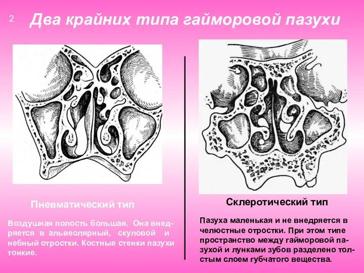 Два крайних типа гайморовой пазухи Пневматический тип Склеротический тип Воздушная