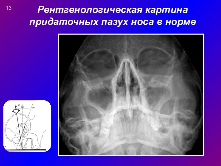 Рентгенологическая картина придаточных пазух носа в норме 13