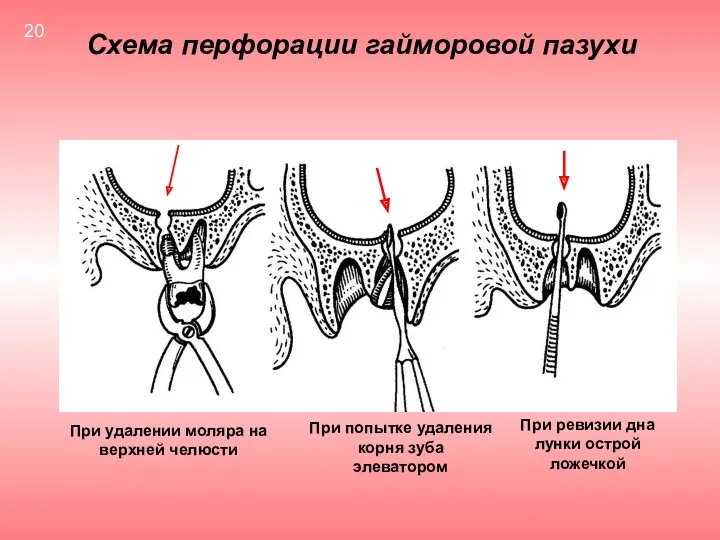 Схема перфорации гайморовой пазухи При удалении моляра на верхней челюсти