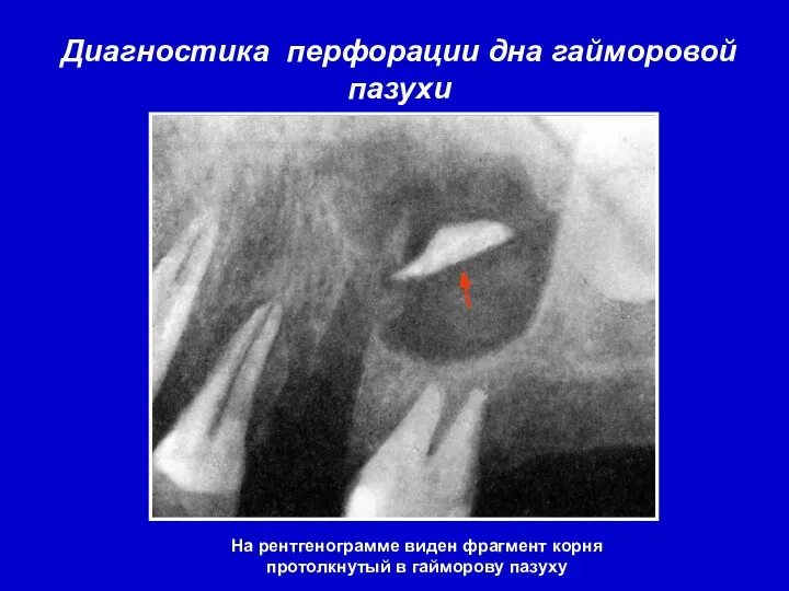 Диагностика перфорации дна гайморовой пазухи На рентгенограмме виден фрагмент корня протолкнутый в гайморову пазуху