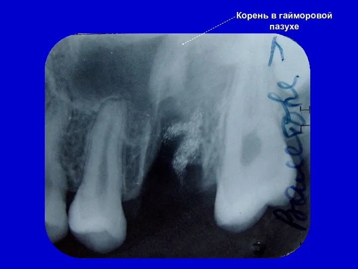 Корень в гайморовой пазухе
