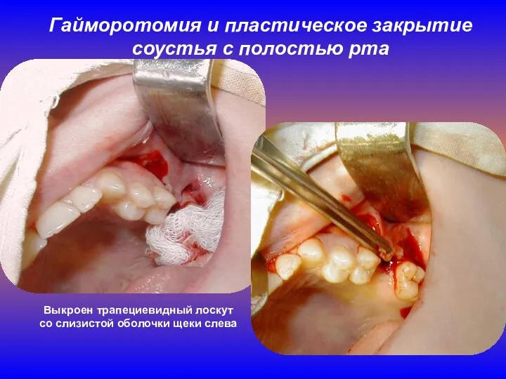 Гайморотомия и пластическое закрытие соустья с полостью рта Выкроен трапециевидный лоскут со слизистой оболочки щеки слева