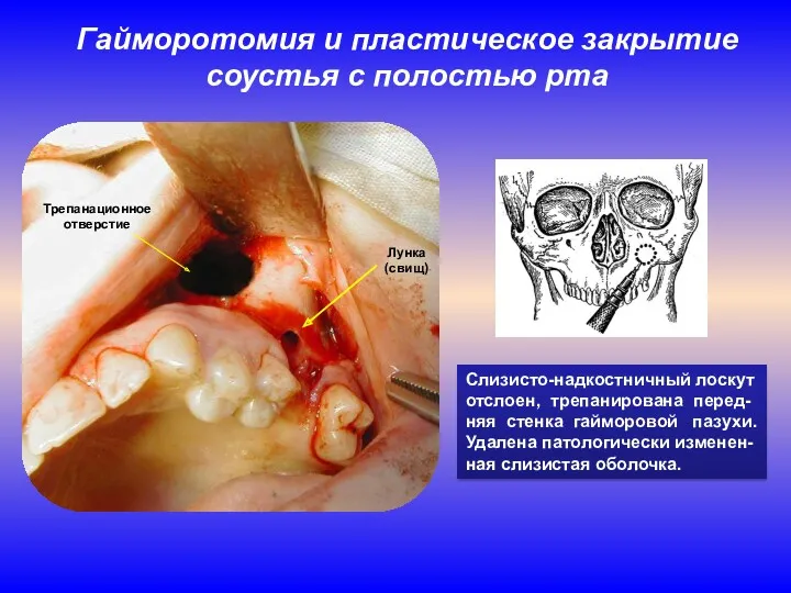 Гайморотомия и пластическое закрытие соустья с полостью рта Слизисто-надкостничный лоскут