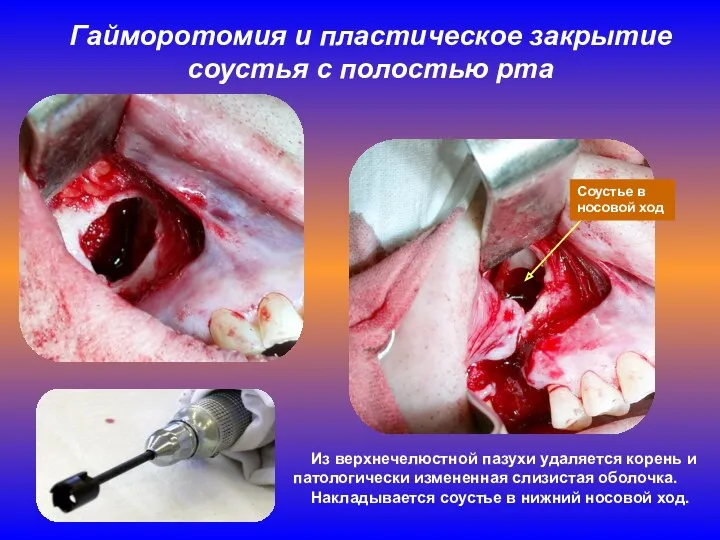 Гайморотомия и пластическое закрытие соустья с полостью рта Из верхнечелюстной