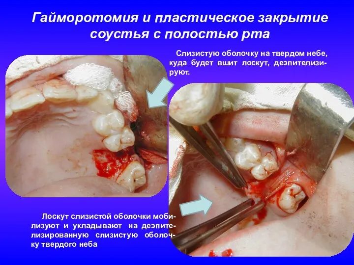 Гайморотомия и пластическое закрытие соустья с полостью рта Слизистую оболочку
