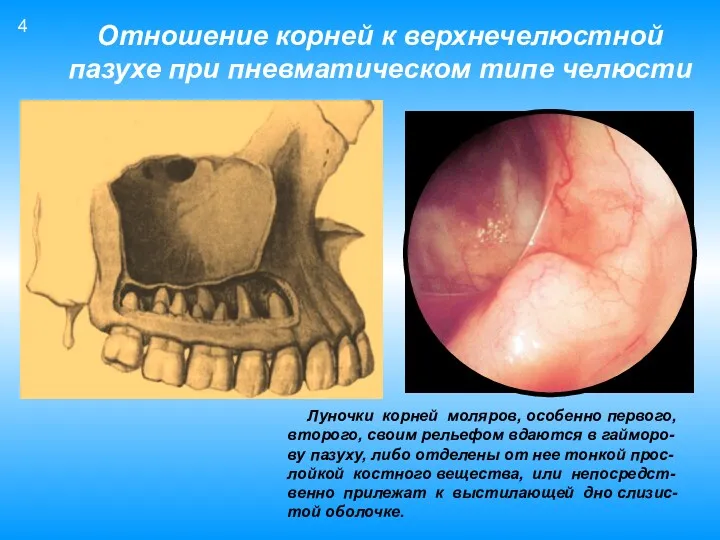 Отношение корней к верхнечелюстной пазухе при пневматическом типе челюсти Луночки