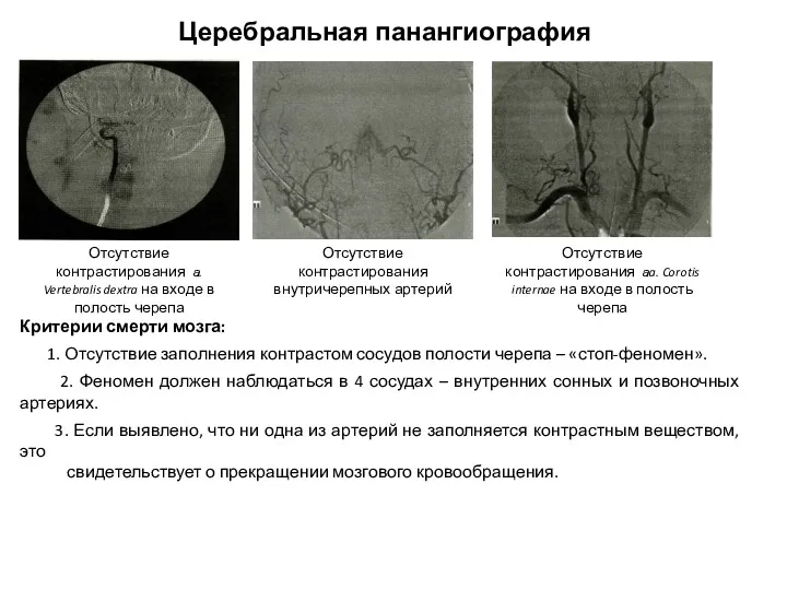 Церебральная панангиография Отсутствие контрастирования внутричерепных артерий Отсутствие контрастирования а. Vertebralis