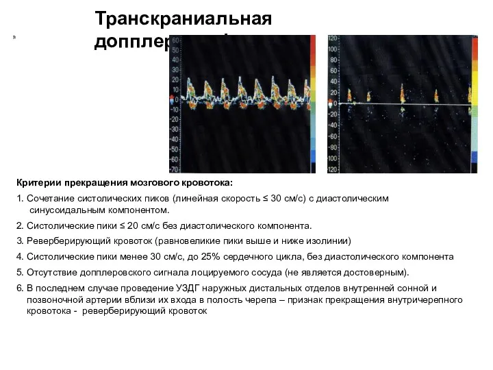 Транскраниальная допплерография Критерии прекращения мозгового кровотока: 1. Сочетание систолических пиков