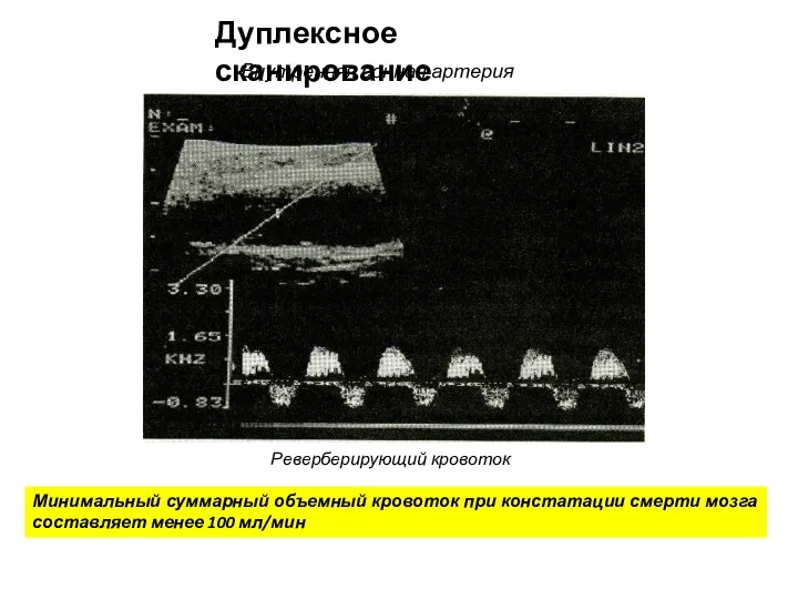 Дуплексное сканирование Внутренняя сонная артерия Реверберирующий кровоток Минимальный суммарный объемный