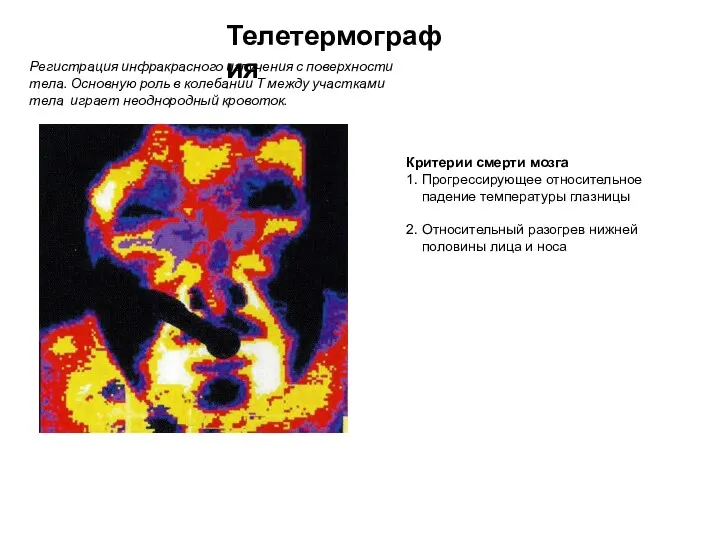 Телетермография Регистрация инфракрасного излучения с поверхности тела. Основную роль в