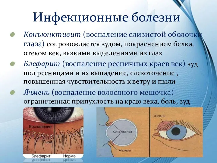 Инфекционные болезни Конъюнктивит (воспаление слизистой оболочки глаза) сопровождается зудом, покраснением