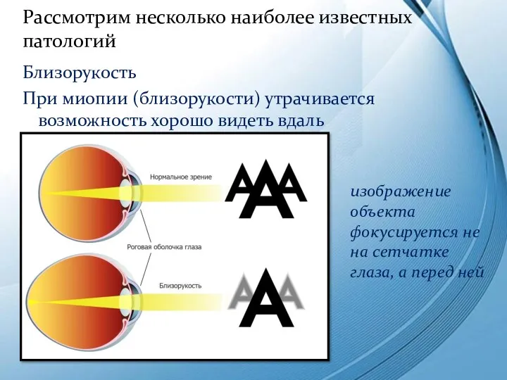 Близорукость При миопии (близорукости) утрачивается возможность хорошо видеть вдаль Рассмотрим