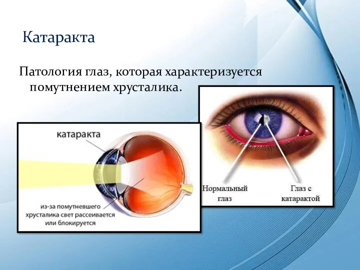 Патология глаз, которая характеризуется помутнением хрусталика. Катаракта