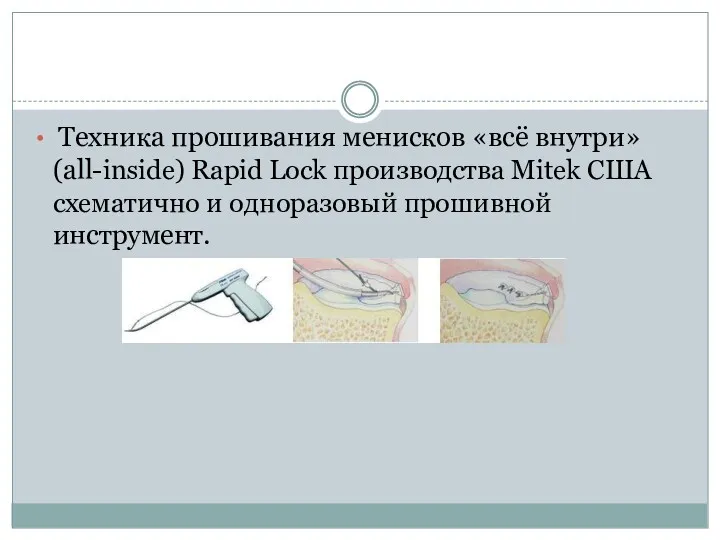 Техника прошивания менисков «всё внутри» (all-inside) Rapid Lock производства Mitek США схематично и одноразовый прошивной инструмент.