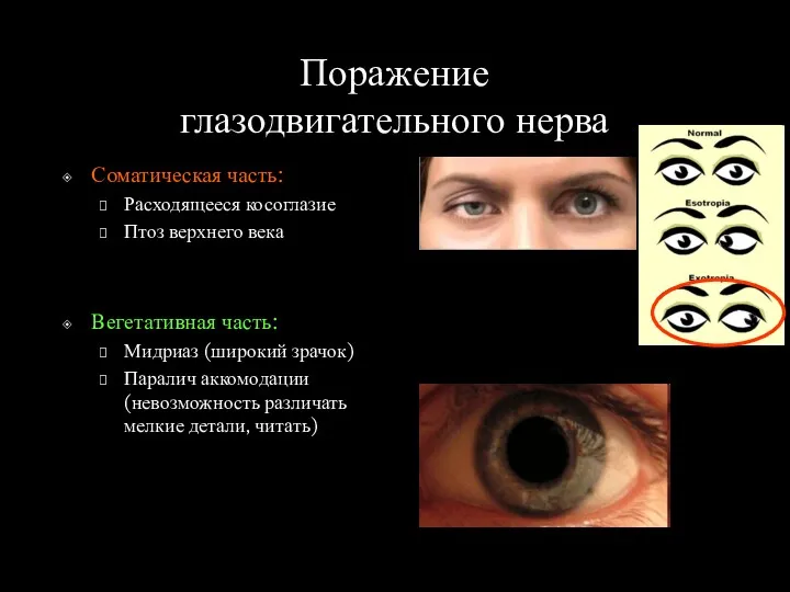 Поражение глазодвигательного нерва Соматическая часть: Расходящееся косоглазие Птоз верхнего века