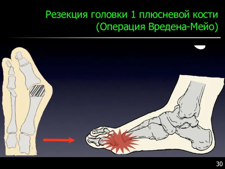 Резекция головки 1 плюсневой кости (Операция Вредена-Мейо)