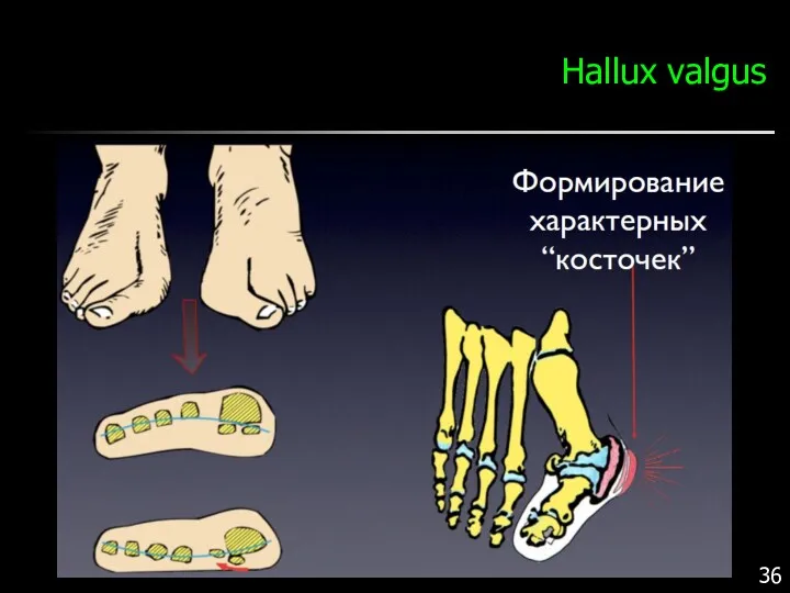 Hallux valgus