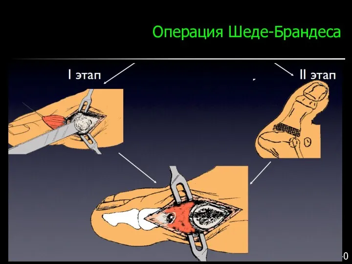 Операция Шеде-Брандеса