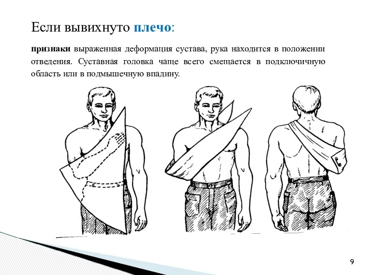 Если вывихнуто плечо: признаки выраженная деформация сустава, рука находится в положении отведения. Суставная
