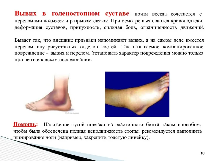 Вывих в голеностопном суставе почти всегда сочетается с переломами лодыжек и разрывом связок.