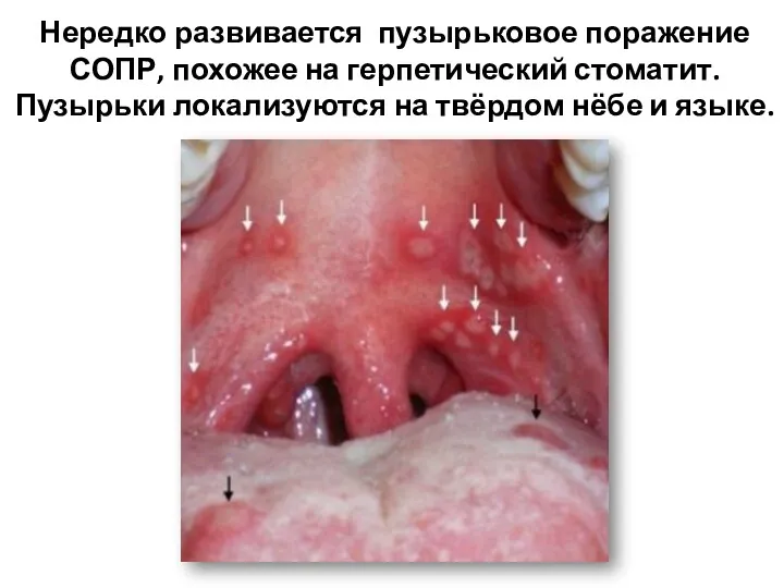 Нередко развивается пузырьковое поражение СОПР, похожее на герпетический стоматит. Пузырьки локализуются на твёрдом нёбе и языке.