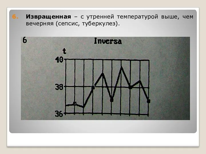 Извращенная – с утренней температурой выше, чем вечерняя (сепсис, туберкулез).