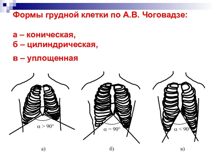 Формы грудной клетки по А.В. Чоговадзе: а – коническая, б – цилиндрическая, в – уплощенная