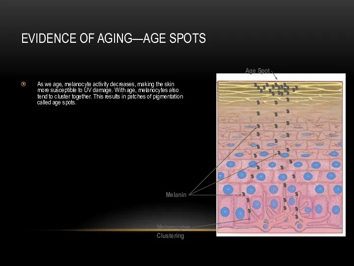 EVIDENCE OF AGING—AGE SPOTS As we age, melanocyte activity decreases,
