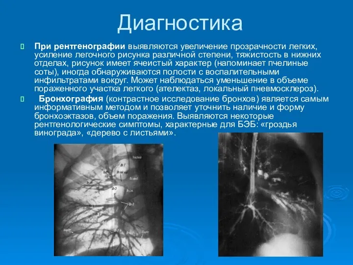 Диагностика При рентгенографии выявляются увеличение прозрачности легких, усиление легочного рисунка