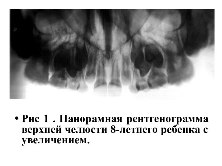 Рис 1 . Панорамная рентгенограмма верхней челюсти 8-летнего ребенка с увеличением.