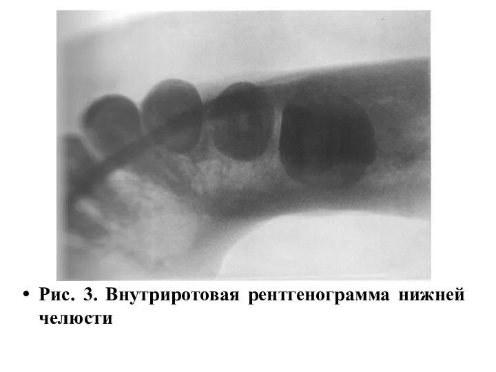 Рис. 3. Внутриротовая рентгенограмма нижней челюсти