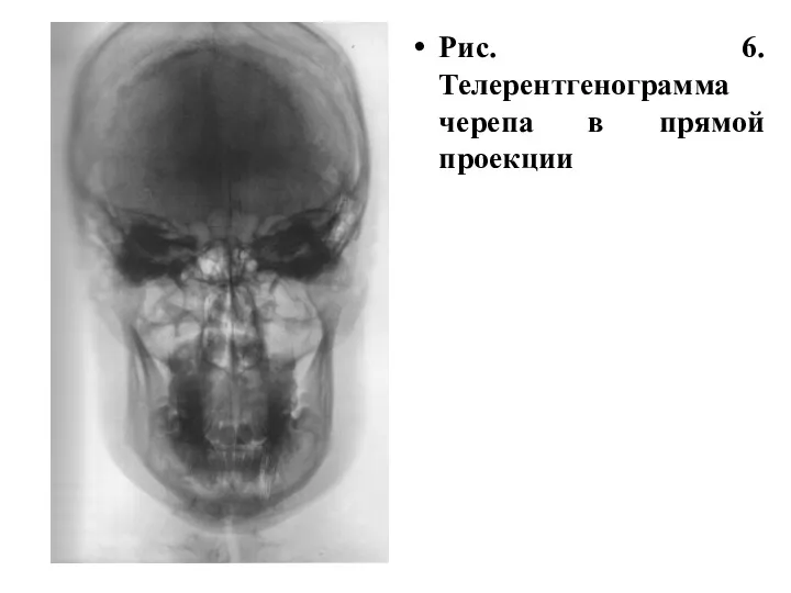 Рис. 6. Телерентгенограмма черепа в прямой проекции