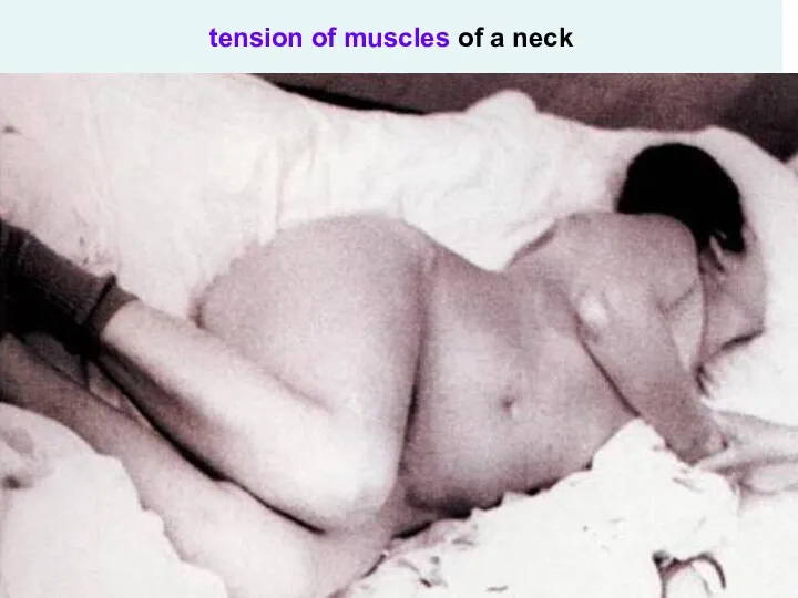 tension of muscles of a neck