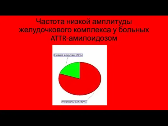 Частота низкой амплитуды желудочкового комплекса у больных ATTR-амилоидозом