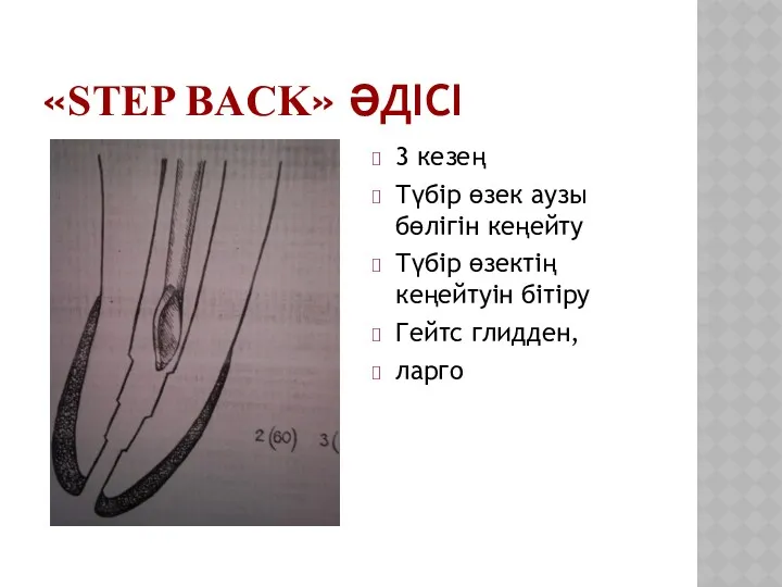 «STEP BACK» ӘДІСІ 3 кезең Түбір өзек аузы бөлігін кеңейту