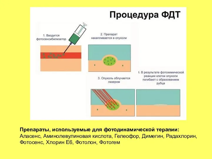 Препараты, используемые для фотодинамической терапии: Аласенс, Аминолевулиновая кислота, Гелеофор, Димегин, Радахлорин, Фотосенс, Хлорин Е6, Фотолон, Фотогем