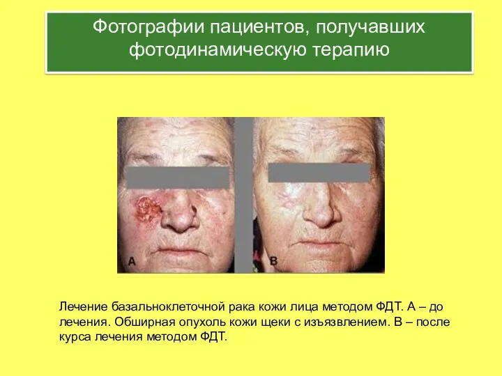 Фотографии пациентов, получавших фотодинамическую терапию Лечение базальноклеточной рака кожи лица методом ФДТ. А