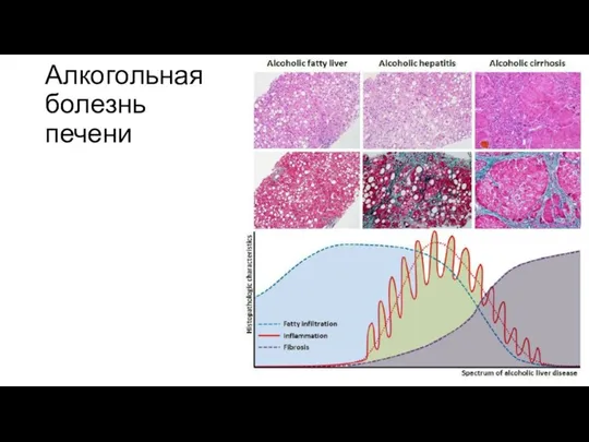 Алкогольная болезнь печени