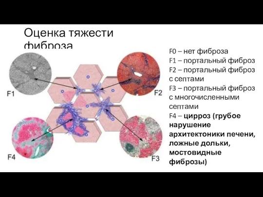 Оценка тяжести фиброза F0 – нет фиброза F1 – портальный