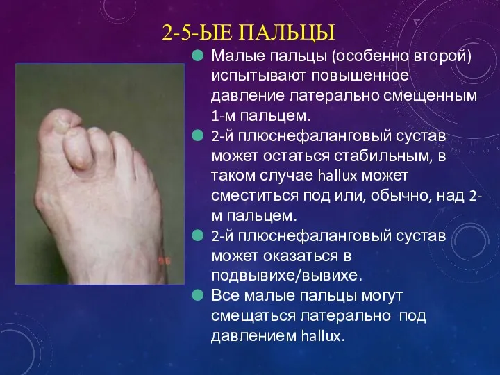 2-5-ЫЕ ПАЛЬЦЫ Малые пальцы (особенно второй) испытывают повышенное давление латерально