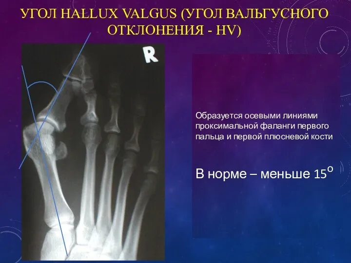 УГОЛ HALLUX VALGUS (УГОЛ ВАЛЬГУСНОГО ОТКЛОНЕНИЯ - HV) Образуется осевыми