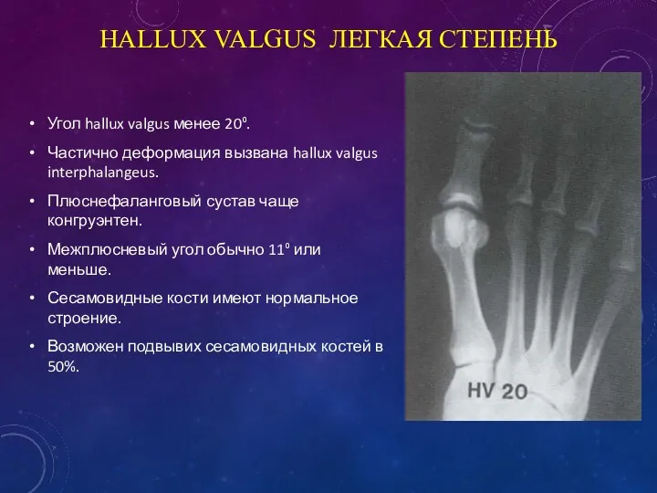 HALLUX VALGUS ЛЕГКАЯ СТЕПЕНЬ Угол hallux valgus менее 20⁰. Частично