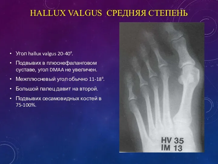 HALLUX VALGUS СРЕДНЯЯ СТЕПЕНЬ Угол hallux valgus 20-40⁰. Подвывих в