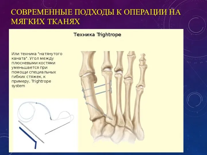 СОВРЕМЕННЫЕ ПОДХОДЫ К ОПЕРАЦИИ НА МЯГКИХ ТКАНЯХ