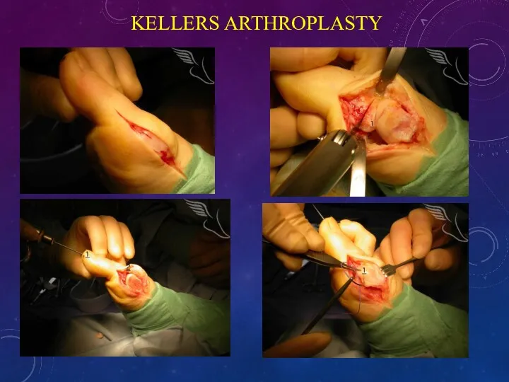 KELLERS ARTHROPLASTY