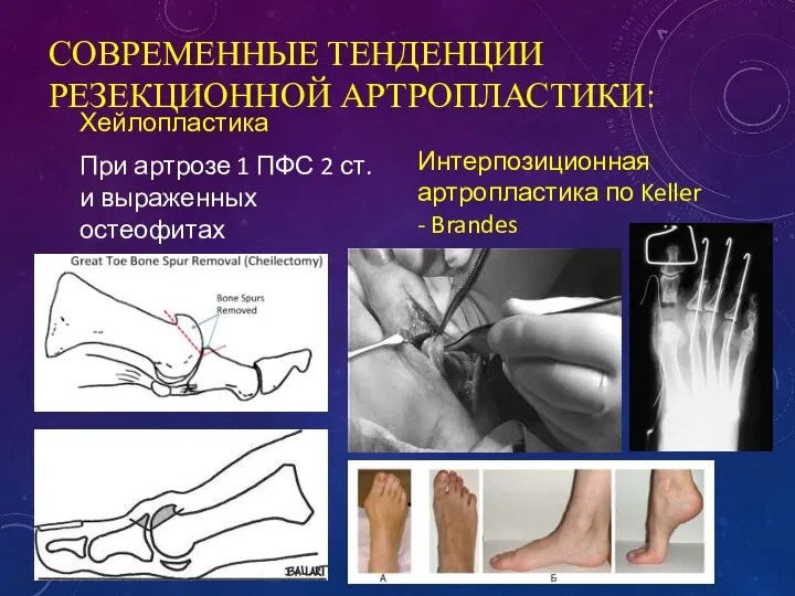 СОВРЕМЕННЫЕ ТЕНДЕНЦИИ РЕЗЕКЦИОННОЙ АРТРОПЛАСТИКИ: Хейлопластика При артрозе 1 ПФС 2