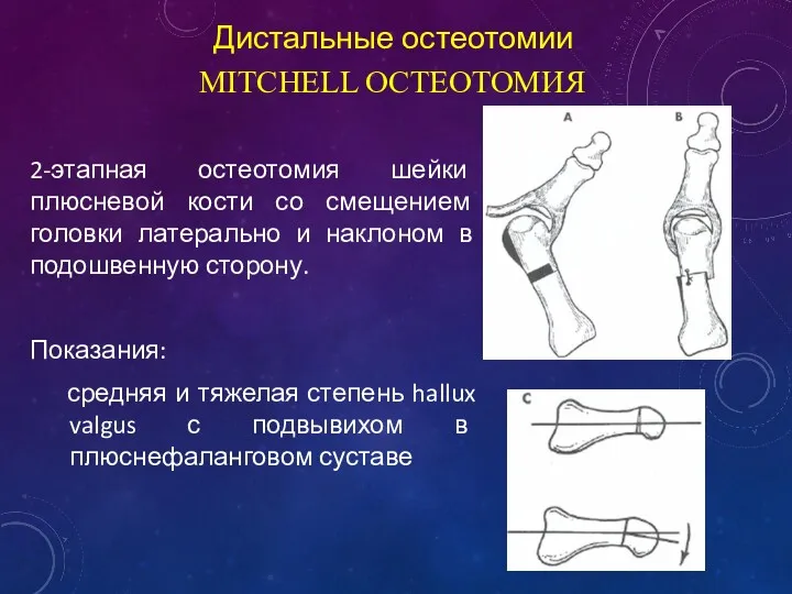 MITCHELL ОСТЕОТОМИЯ 2-этапная остеотомия шейки плюсневой кости со смещением головки