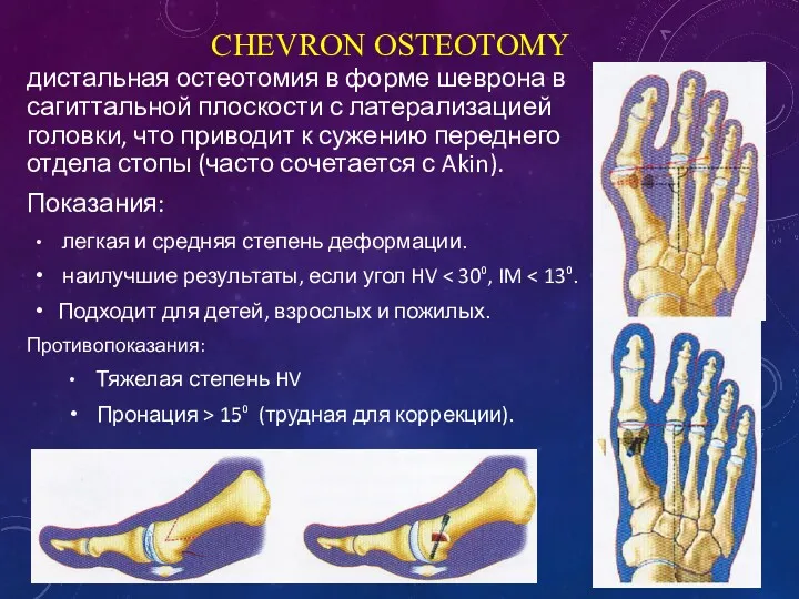 CHEVRON OSTEOTOMY дистальная остеотомия в форме шеврона в сагиттальной плоскости