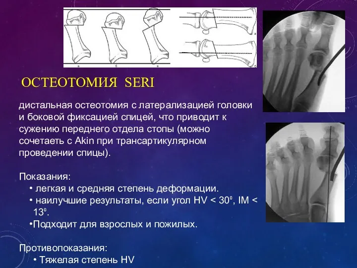 ОСТЕОТОМИЯ SERI дистальная остеотомия с латерализацией головки и боковой фиксацией